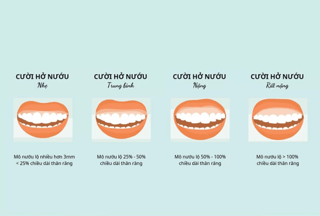 Cười hở lợi phải làm sao? Việc phải làm phụ thuộc vào nguyên nhân và mức độ cười hở lợi