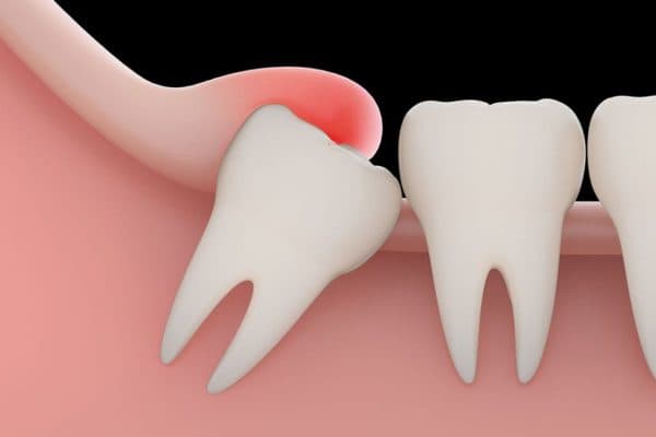 Viêm lợi trùm bao lên răng hàm số 8 gây sưng tấy, đau nhức