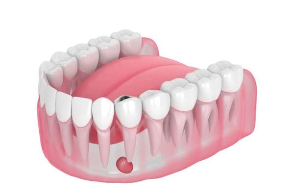 Viêm nhiễm xảy ra ở các tổ chức quanh răng được gọi là viêm chân răng