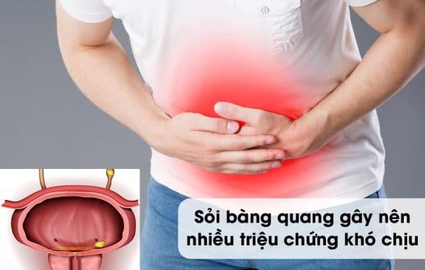 Điều trị sỏi bàng quang sớm để tránh những cơn đau