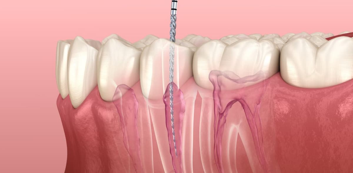 Quá trình điều trị tủy răng có lâu không?