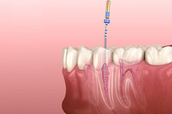 Điều trị tủy răng sớm để ngăn ngừa tình trạng đau nhức, ê buốt và giảm nguy cơ biến chứng