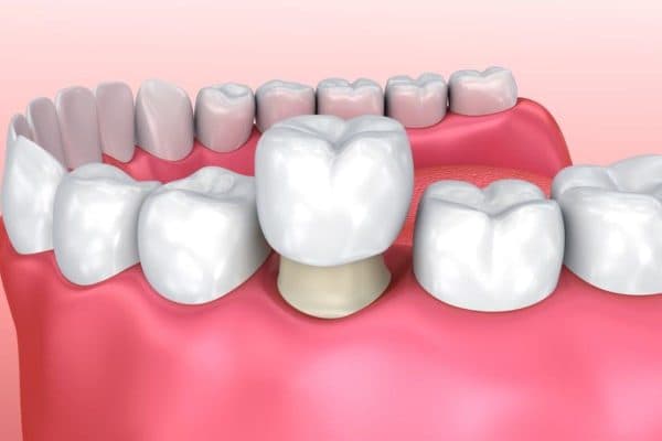 Điều trị tủy răng có nên bọc sứ không cần được đánh giá trên rất nhiều yếu tố