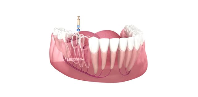 Điều trị tủy răng như thế nào đúng cách?