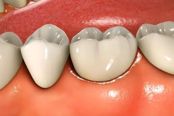 Khi bị viêm lợi, mọi người tường gặp phải tình trạng sưng tấy nướu răng, đau nhức, chảy máu chân răng...