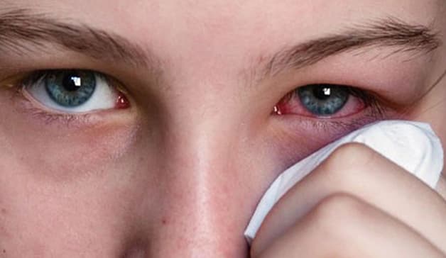 lẹo mắt có tự khỏi không