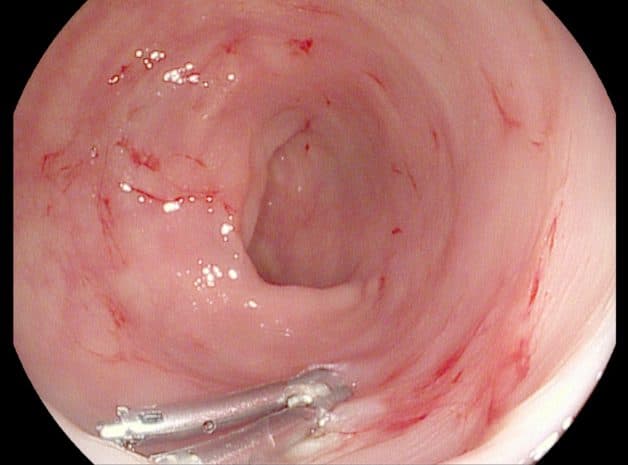 viêm loét bờ cong nhỏ có thể dẫn đến xuất huyết dạ dày