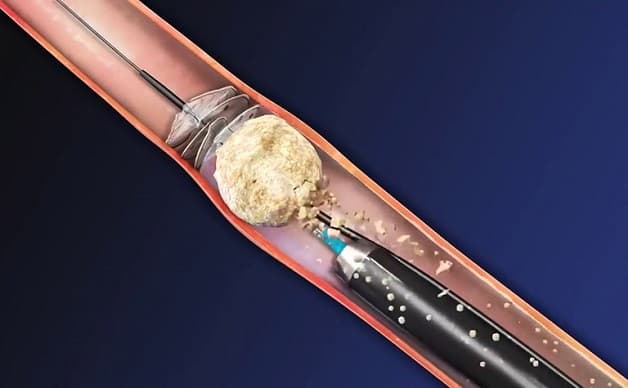 Nội soi tán sỏi niệu quản là phương pháp điều trị được lựa chọn nhiều nhất hiện nay