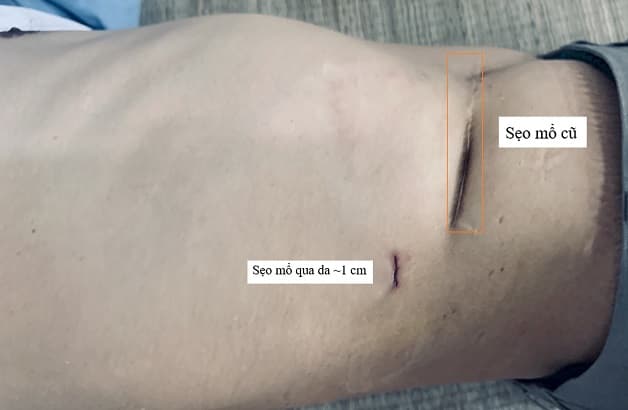 Phương pháp này để lại sẹo nhỏ hơn mổ mở