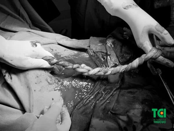 cứu sống cặp song thai