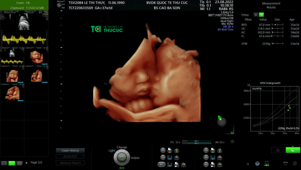 cứu sống cặp song thai