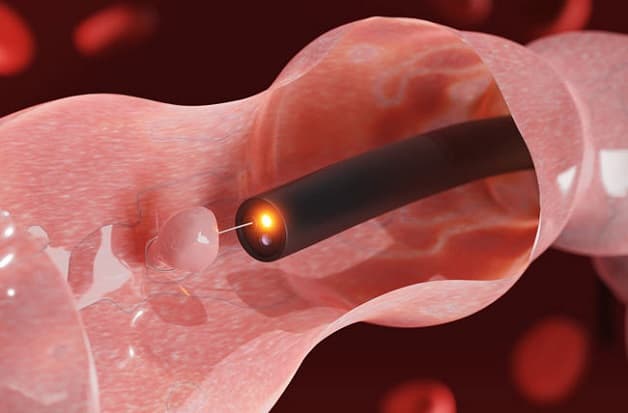 Polyp đại tràng tiềm ẩn nguy cơ ung thư