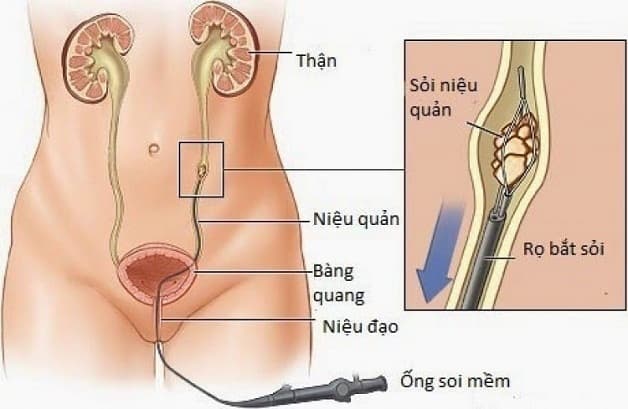 Sỏi bàng quang và cách điều trị hiện nay khá đa dạng