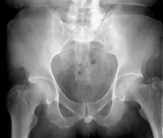 Sỏi niệu đạo nữ là bệnh lý thường gặp 