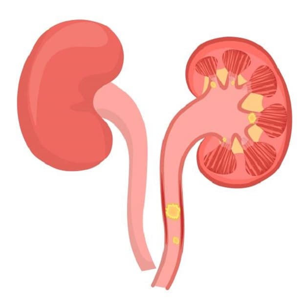 Những loại thuốc điều trị sỏi niệu quản