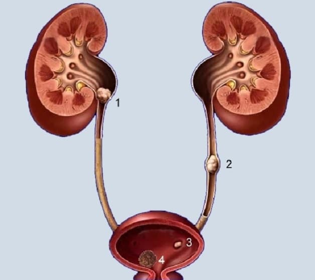 Diễn biến của sỏi thận rơi kẹt tại bàng quang