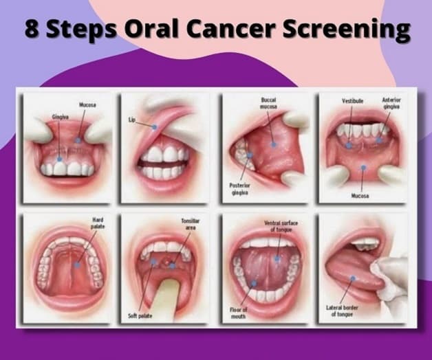 sàng lọc ung thư khoang miệng