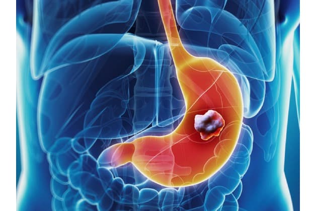 tầm soát ung thư gan