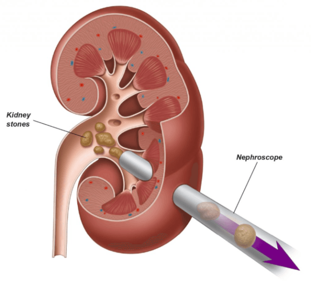 Điều trị tán sỏi thận hết bao nhiêu tiền