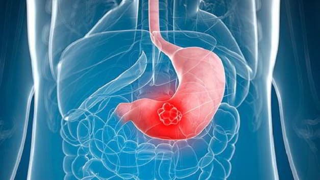 Viêm dạ dày là bệnh lý đường tiêu hóa thường gặp