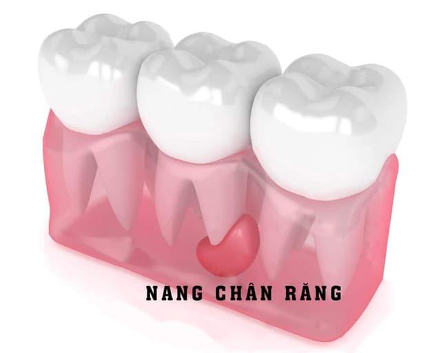 U chân răng: Nhận biết và điều trị