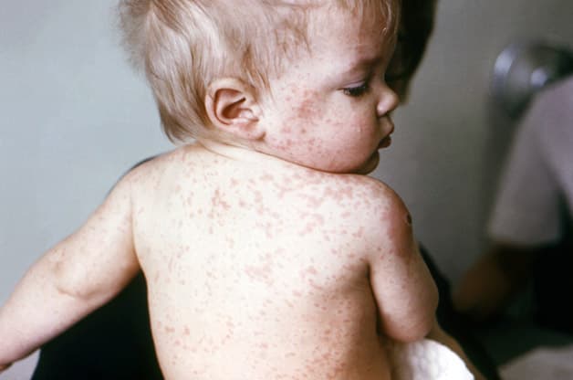 Vắc xin sởi quai bị Rubella là 