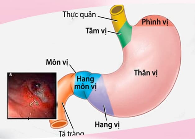 Viêm niêm mạc hang vị là bệnh lý thường gặp ở hệ tiêu hóa