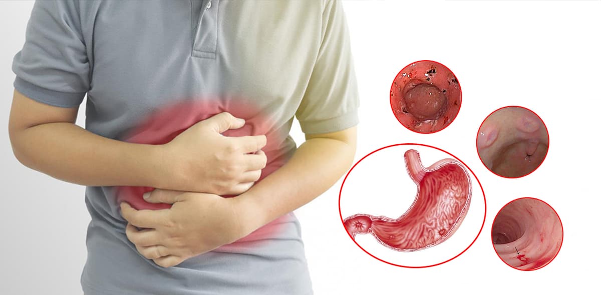 Viêm trợt niêm mạc hang vị dạ dày: Dấu hiệu và cách điều trị