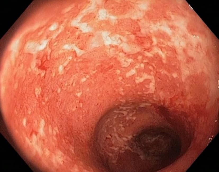 Loét trực tràng: nguyên nhân, triệu chứng và cách điều trị