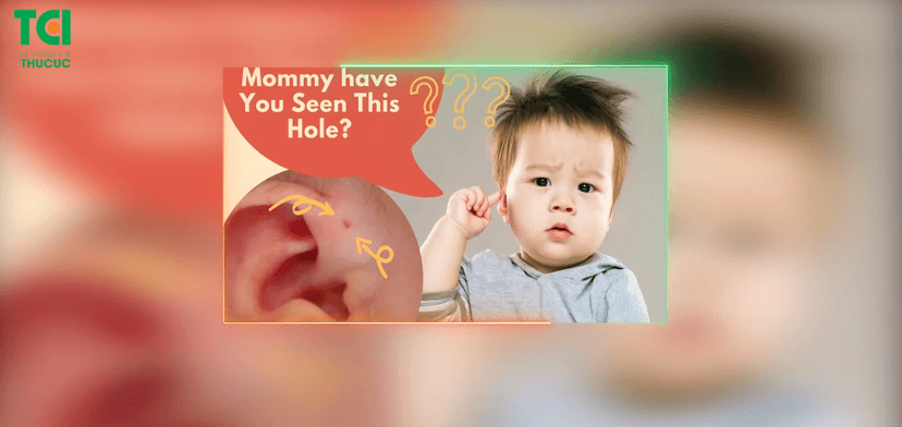 Phẫu thuật lấy lỗ rò luân nhĩ thành công