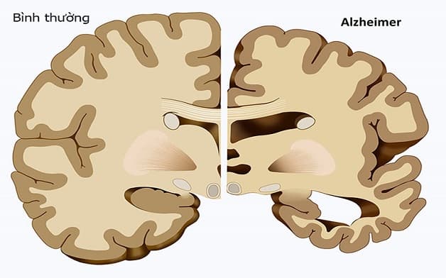 Bệnh Alzheimer là gì?