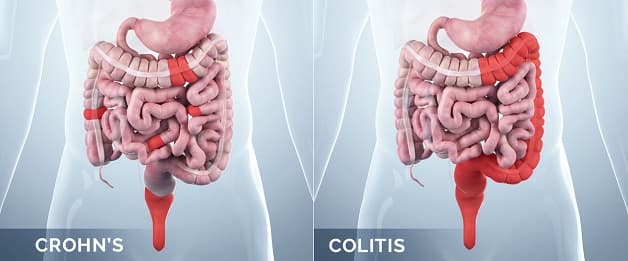 Bệnh Crohn là gì?