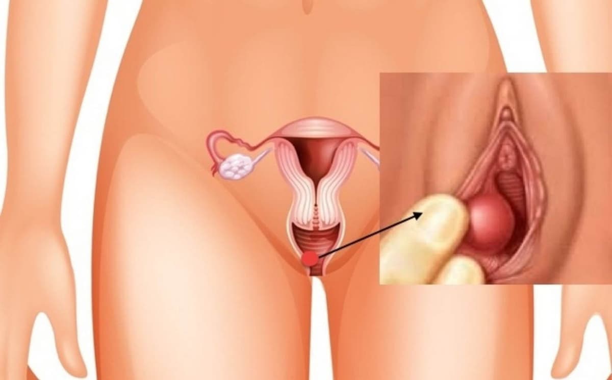 Biến chứng viêm âm đạo chị em cần lưu ý