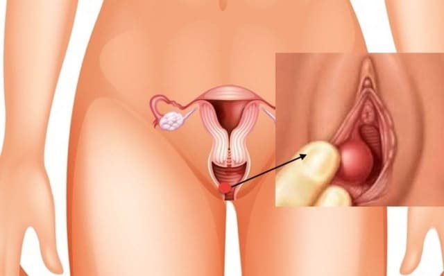 Biến chứng viêm âm đạo chị em cần lưu ý