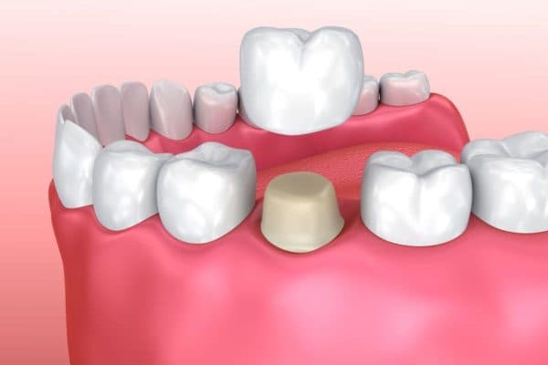 Mài quá nhiều răng sẽ làm tổn thương và lộ ngà răng, khiến răng dễ ê buốt