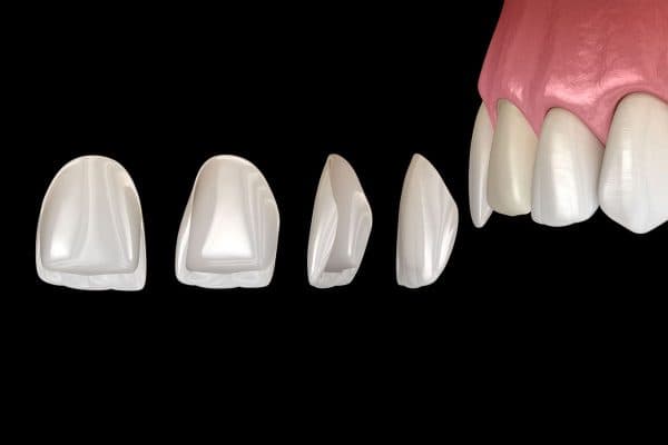 Mặt dán sứ được dán trực tiếp lên răng thật sau khi mài để phục hình