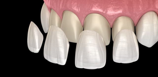 Tìm hiểu phương pháp dán răng sứ veneer là gì?