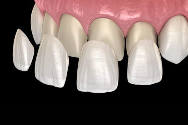 Dán răng sứ veneer là gì, là một kỹ thuật phục hình bằng việc dán mặt sứ lên trên răng thật 
