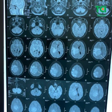 Mất ngủ đau đầu buồn nôn coi chừng u màng não