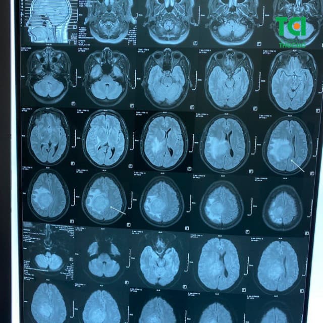 Mất ngủ đau đầu buồn nôn coi chừng u màng não