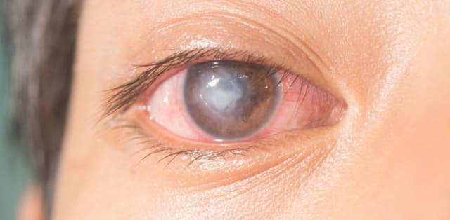 Loét giác mạc: Nguyên nhân, biểu hiện và phương pháp điều trị