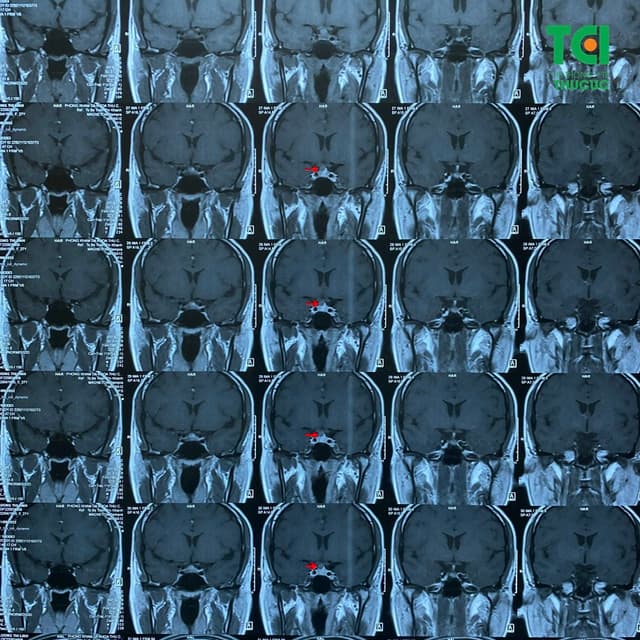 Nguyên nhân mất ngủ kéo dài do u tuyến yên