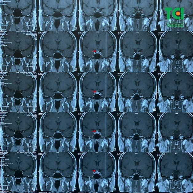 u tuyến yên gây mất ngủ kéo dài trên phim chụp MRI 