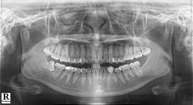 Phần lớn răng khôn nằm lệch, xô đẩy các răng lân cận
