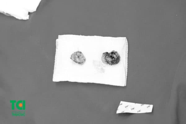 phẫu thuật cắt amidan