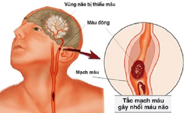 phòng ngừa đột quỵ bằng cách cải thiện đủ máu lên não