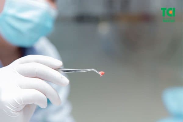 Loại bỏ chân răng số 8 bị sót một cách dễ dàng chỉ sau chưa đầy 10 phút nhờ thực hiện bằng công nghệ Piezotome