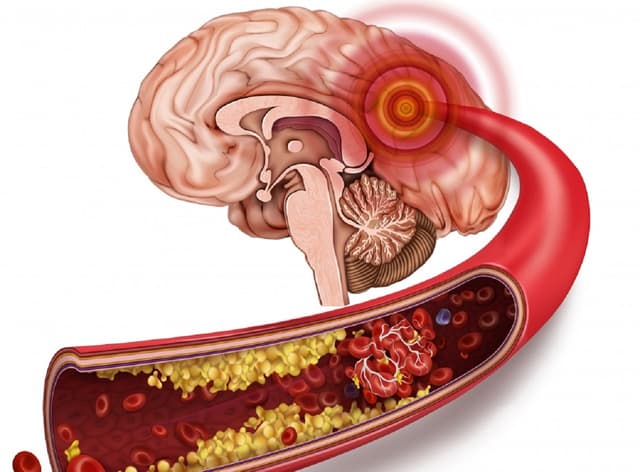 Tắc mạch máu não: Nguyên nhân, triệu chứng và cách xử trí