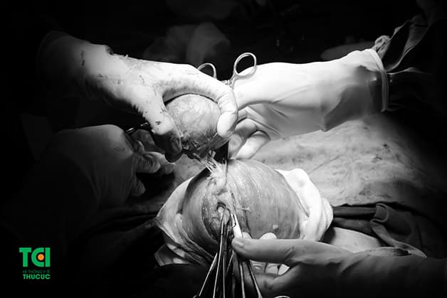 U xơ tử cung dưới niêm mạc có thể gây ra nhiều vấn đề đáng ngại với phụ nữ mang thai