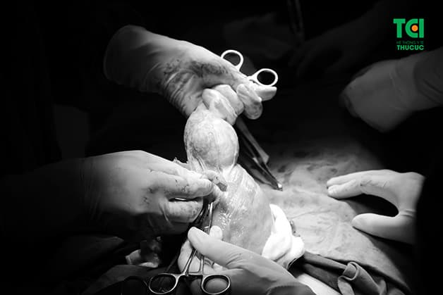 U xơ tử cung có thể gây ra nhiều ảnh hưởng nghiêm trọng tới sức khỏe nếu không được kiểm soát kịp thời